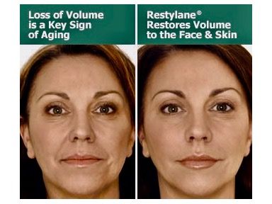 2 Restylane Filler Treatments