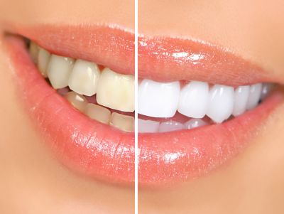 Professional Teeth Whitening