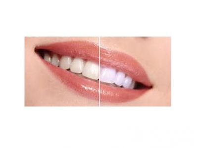 Custom Teeth Whitening Trays