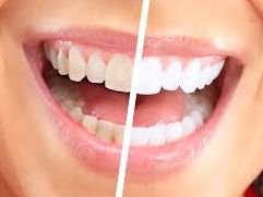 SinSational Smile Teeth Whitening Session